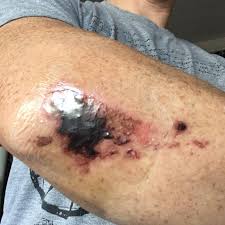 Post #8 of 10 (26051 views) i had road rash with the secretion you are talking about for days. Road Rash Care With Tegaderm Staminist Cycling Forum
