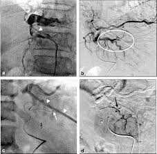 May 14, 2021 · the procedure, usually carried out under general anaesthetic, involves the passage of an endoscope, inserted orally (or sometimes percutaneously), into the biliary tract. The Complication Of Hepatic Artery Injuries Of 1 304 Percutaneous Transhepatic Biliary Drainage In A Single Institute Journal Of Vascular And Interventional Radiology