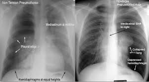 Image result for Pulmonary Contusion