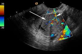 Sagittal image of right ovary (sag rt, calipers). Ovarian Cancer Color Doppler