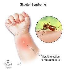 Image result for mosquito bite