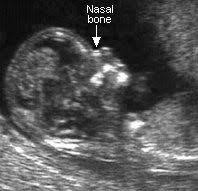 Women who cannot recall the dating scan with an ultrasound performed from the huggies pregnancy ultrasound screening test. Pin On Babies