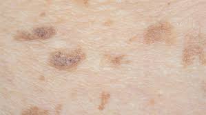 Maybe you would like to learn more about one of these? Pigmentflecken Focus Arztsuche