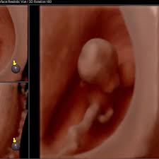 Ultrassom Crc Arcos Sonoembriologia 3d Em 8 Semanas De Idade Gestacional Facebook
