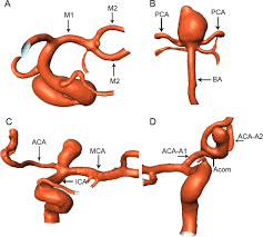 Maybe you would like to learn more about one of these? Asymmetrical Than Symmetrical Cerebral Arterial Bifurcations Are More Vulnerable To Aneurysm Presence Scientific Reports