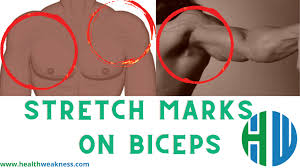 However, playing around with the height of your hands, position of your palms or arm angle can put the emphasis into the biceps. How To Treat Stretch Marks On Biceps 2021 Healthweakness