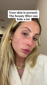 Anyone out there feeling insecure about your skin just know its normal and  it gets better 🫶🏼