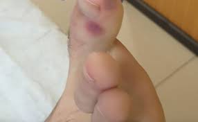 باحثون يكتشفون علامات في الأقدام تدل على الإصابة بكورونا الحرة