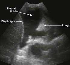 Check spelling or type a new query. Thoracentesis Clinical Gate