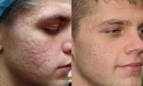 1540 Fractional Resurfacing 2 Treatments Post Elizabethhagen Yepididthat Masteraesthetician Absoluteaesthicsllc Laser Treatment Treatment Skin