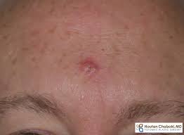Not only does the stage tell you how serious the disease is, but it can help you and. Skin Cancer Reduction With Coffee And Tea