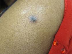 This can often heal without treatment. Dermatofibroma Symptoms Causes Treatment Toronto Dermatology Centre