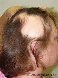 Alopecia Areata American Osteopathic College Of Dermatology Aocd
