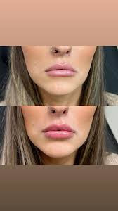 Don’t worry Mama, we’re just having fun 😉, Another syringe for this  beauty! Last slide shows where she started a couple years ago. , #lipfiller  #restylane #rhafiller #perfectpout #juicylips ...