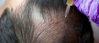 There are many hair transplant clinics in delhi ncr but, only. Cheapest Prp Treatment In Delhi