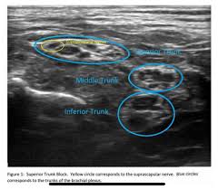 Image result for Superior Trunk Block