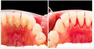 Remove Tartar Buildup Fast With These 4 Natural Ingredients Health Remedies Plaque Removal Teeth Health