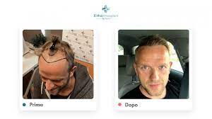 Secondo le statistiche circa il 20% dei giovani intorno ai 20 anni è soggetto ad una precoce (o precocissima) . Calvizie Giovanile Quando I Capelli Cadono A 20 Anni La Repubblica