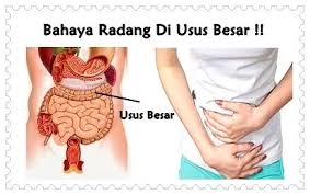 Pentingnya Mengetahui Gejala Dan Penyebab Radang Usus Pengobatan Alternatif Obat Alami