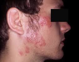 On the other hand, keratinocytes and. Herpes Gladiatorum Causes Symptoms Diagnosis Treatment