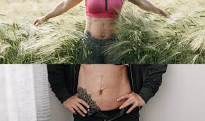 Typisch für einen nabelbruch, eine hernie im nabelbereich, ist eine vorwölbung in der nabelgegend. Bauchnabelbruch Rektusdiastase Operieren Oder Nicht Mama Moves