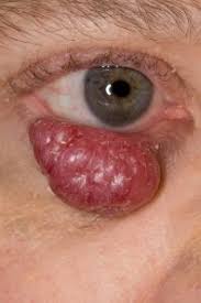 Image result for Merkel Cell Carcinoma