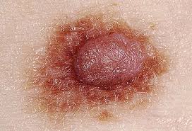 Skin cancer is by far the most common type of cancer. Skin Cancer Symptoms Types Images