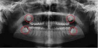 Three Strikes And You Re Out What Are Third Molars
