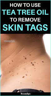 How To Remove Skin Tags With Tea Tree Oil Skin Tags Essential Oils Tea Tree Oil For Acne Skin Tag Removal