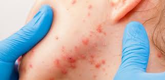 Confira todos os nossos conteúdos sobre graus de acne. Acne O Que E Como Se Forma Tipos De Tratamento E Cuidados Necessarios
