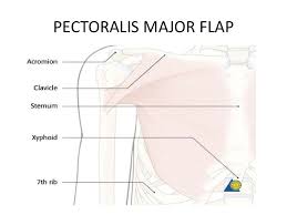 Anterior surface of medial half of clavicle; Pectoralis Major Flap