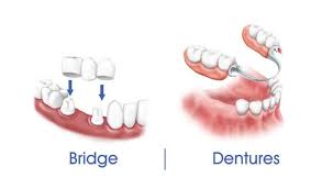 Because of the smaller size, metal dentures are often easier to adjust to than acrylic dentures. Bridges And Partial Dentures The Dental Studios
