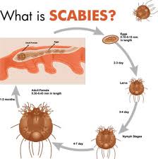 Image result for what does scabie look like