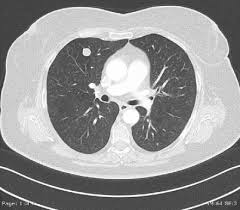 Lungehamartomer er almindeligvis solitære og vokser langsomt. Lokaltherapie Solitarer Intrapulmonaler Maligner Rundherde Springerlink