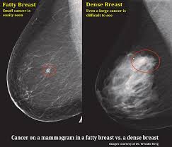 Do i have to follow a strict diet after being diagnosed with cancer or i can eat what i want? Fibroglandular Densities Mammographic Breast Density Itn