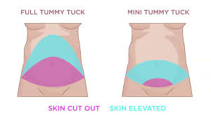 Full Tummy Tuck Vs Mini Tummy Tuck Surgery Memorial Plastic Surgery Mini Tummy Tuck Tummy Tucks Tummy Tuck Surgery