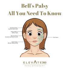 You might think it's a stroke, but it's not. Bell S Palsy All You Need To Know Elevate Physiotherapy