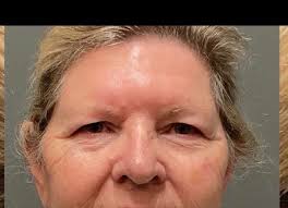 Upper blepharoplasty recovery at 6 weeks