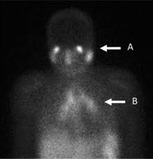 A positron emission tomography (pet) scan detects abnormal cell metabolism to diagnose cancer, heart disease, and brain disorders before other tests can. Gallium Scan Wikipedia