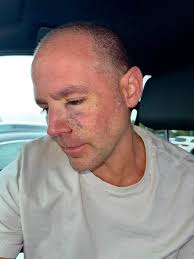 Plastic Surg€ry is successful. Thank you God! And thank you all for the  support, encouragement and prayers! Now healing begins. Btw, the cancer  spot was a size of a penny and also