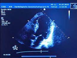 In leichten fällen reicht körperliche schonung als therapie. Echokardiographie Die Kardiologen Freiburg