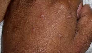 Infants that are breastfed have a lower risk of asthma, obesity, ear and respiratory infections, sudden infant death syndrome, and gastrointestinal infections such as diarrhea. Acropustulosis In Infants Symptoms Causes And Treatment