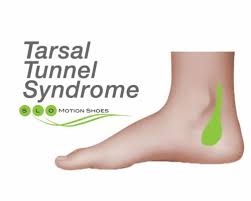 Tarsal Tunnel Syndrome Slo Motion Shoesslo Motion Shoes