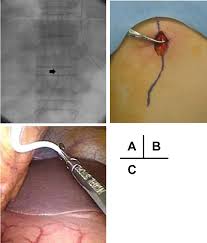 Surgical Findings A Ventriculoperitoneal Vp Shunt Catheter Arrow Download Scientific Diagram