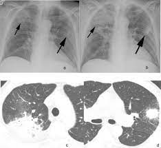 Chronic Airspace Diseases Sciencedirect