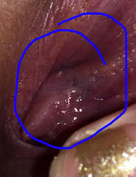 Vestibular Papillomatosis: A Normal Variation Commonly Misdiagnosed As  Genital Condylomata