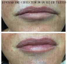 This client has chosen to start the process of having theirs removed. How To Remove Permanent Makeup On Lips Saubhaya Makeup