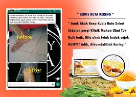 Campur dengan air lemon, oleskan pada kulit yang timbul kudis. Mengalami Masalah Kudis Bedak Sejuk Tradisional Terlaris Facebook