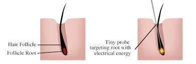 Everything you need to know about electrolysis hair removal. Marla Mintz Electrolysis