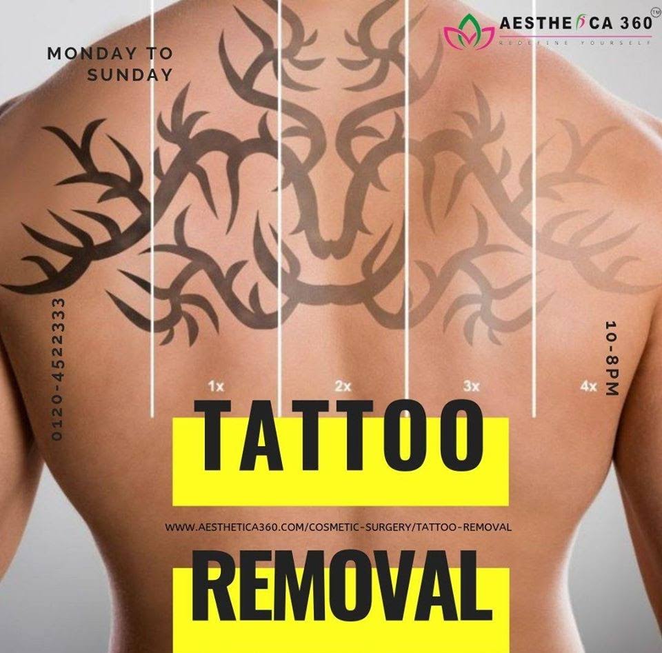 Tattoo Removal product image